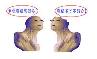 股骨头坏死塌陷