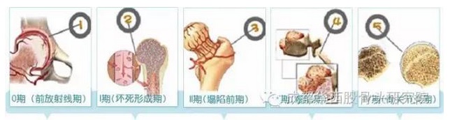 股骨头坏死